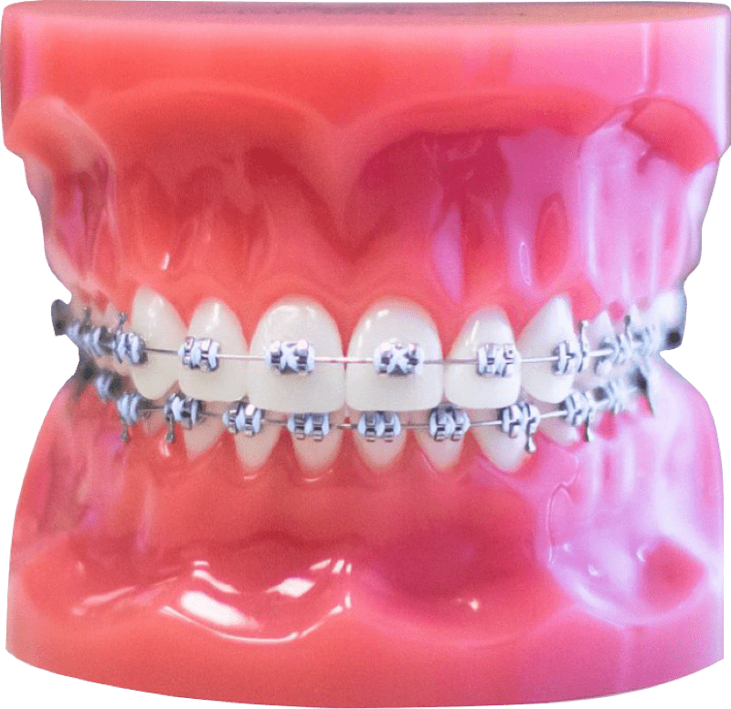 metal braces on plastic typodont model