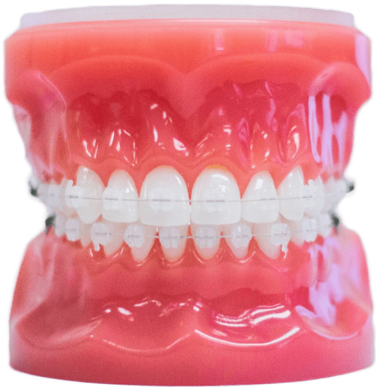 clear braces on plastic typodont model