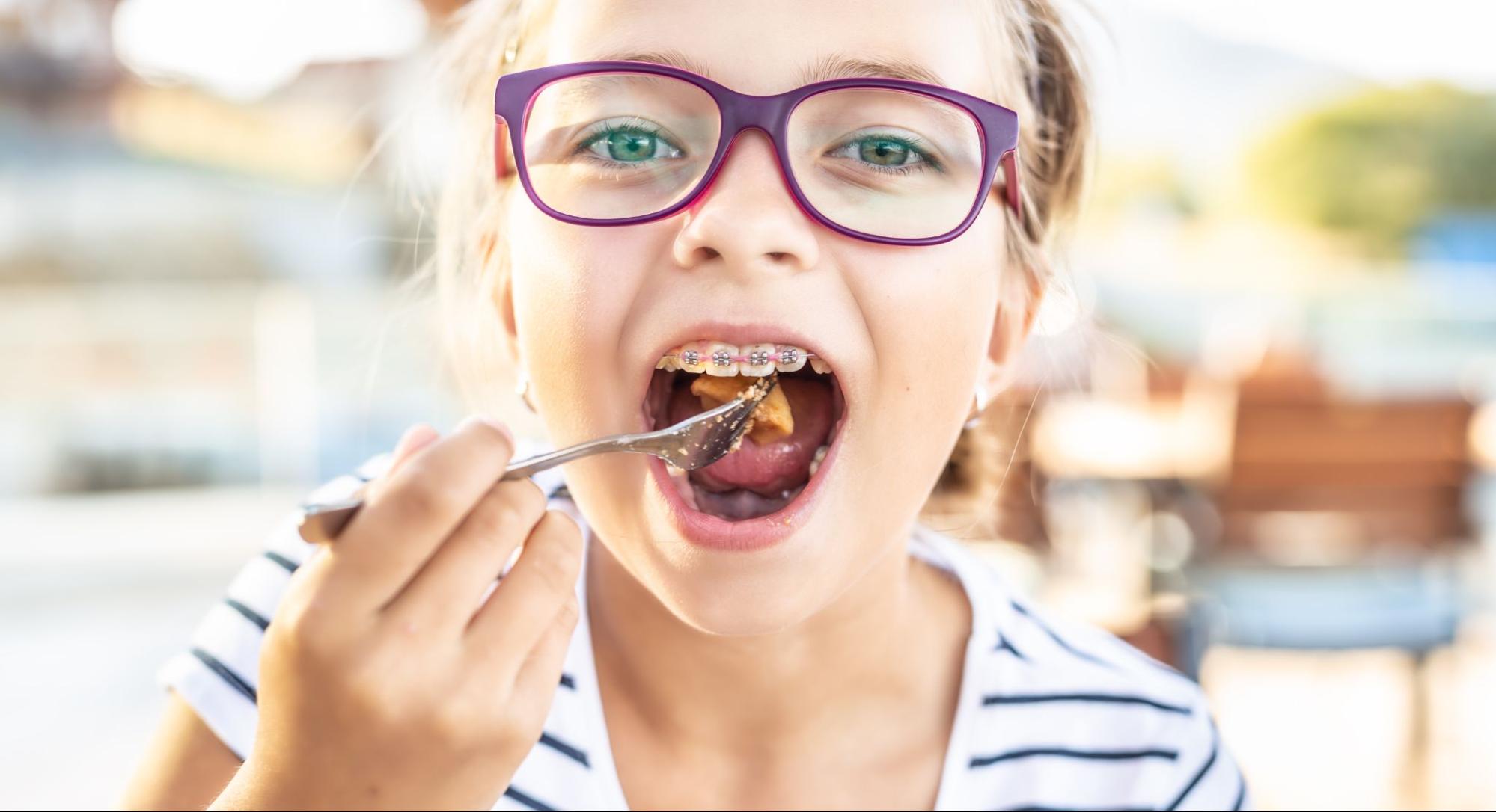 Survival Guide to Eating with Braces (Without Missing Out)