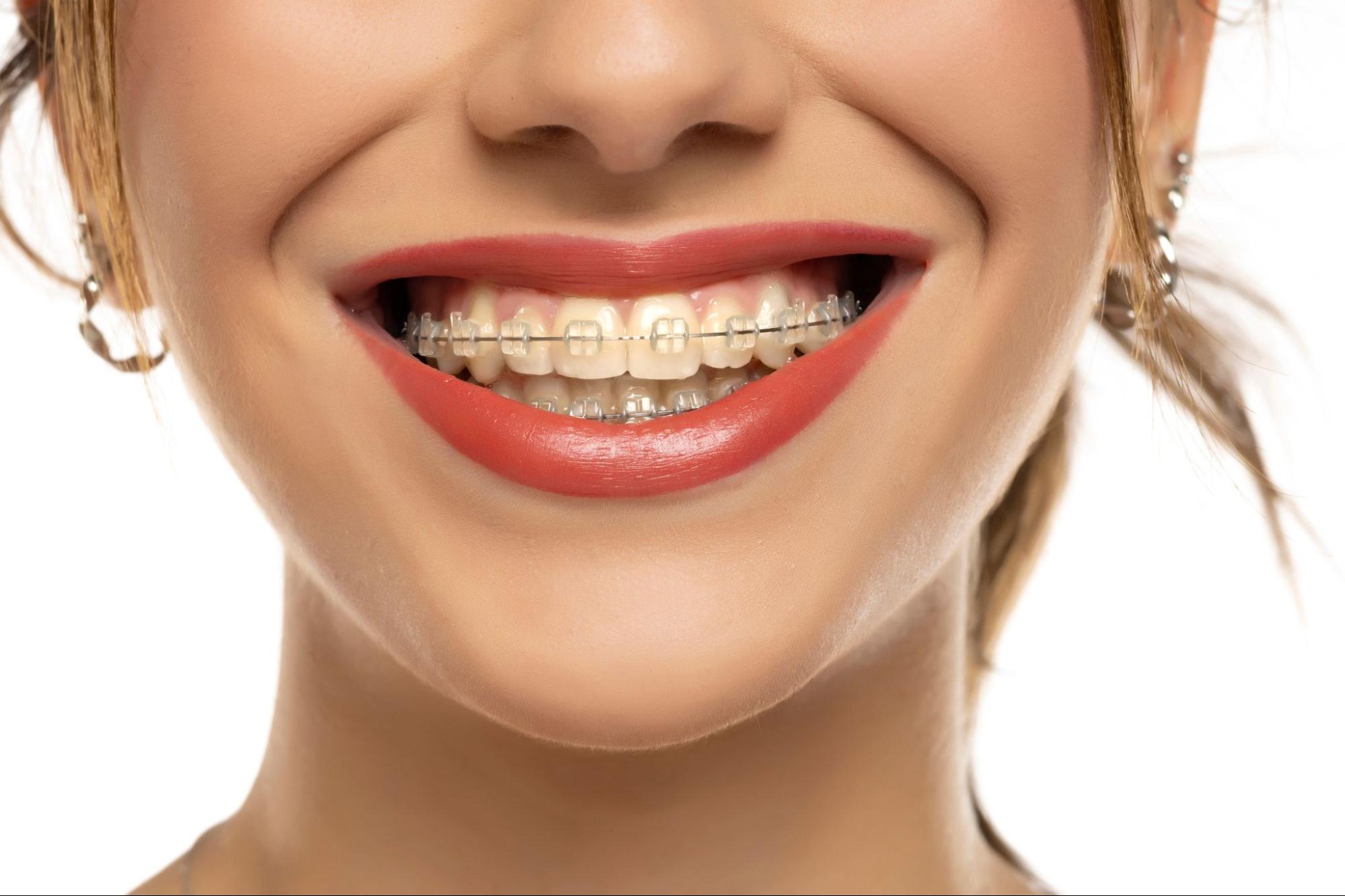 A Beginner&rsquo;s Guide to Clear Braces